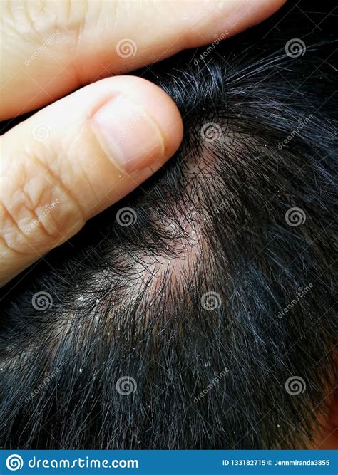 Scaly Scalp And Dandruff Stock Image Image Of Germ 133182715