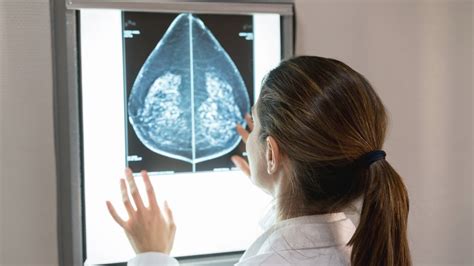 What Does Breast Cancer Look Like On A Mammogram Youtube