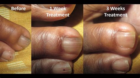 Nail Fungus Treatment Before And After Week 2 To 3 Youtube