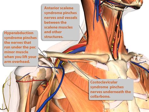 Thoracic Outlet Syndrome Treatment Innova Pain Clinic