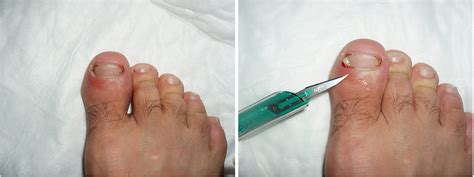 Paronychia occurs when a bacterium or fungus finds its way under the cuticle and into the nail bed. Paronychia: Infection of the skin medial and inferior ...