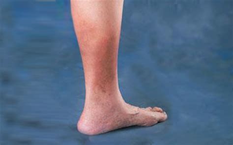 Light Brown Spots On Lower Legs
