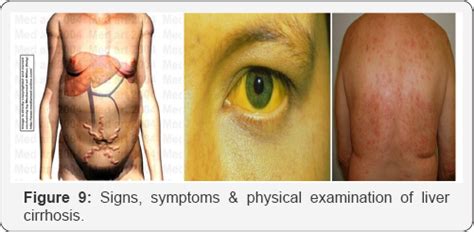 Not always due to a alcohol abuse. Gastroenterology Open Access Journals | Gastroenterology ...