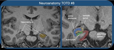 Neuroanatomy Totd 8🧵 18 Mri Shows The Hippocampal Formation The