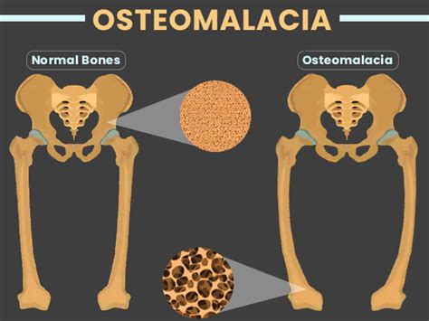 Osteomalacia Causes Symptoms Risk Factors Diagnosis And Treatment