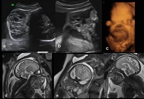 Lymphatic Malformation Of Tongue In A Newborn Eurorad