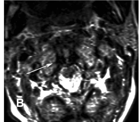 Upper Cervical Spine MRI Radiology Key