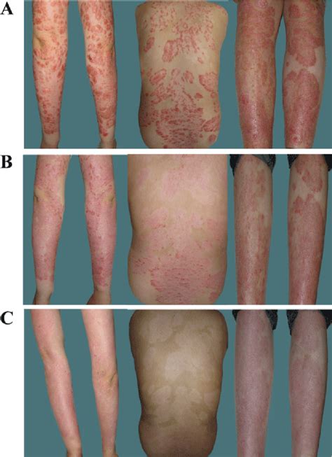 Figure 2 From Successful Treatment Of Severe Psoriatic Arthritis And Psoriasis With Double