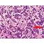 Cureus  Paraneoplastic Leukocytosis A Poor Prognostic Marker In