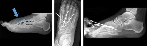 Lisfranc Injury Orthopaedic Trauma Association Ota