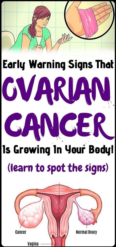 Very Early Signs Of Ovarian Cancer You Might Be Ignoring