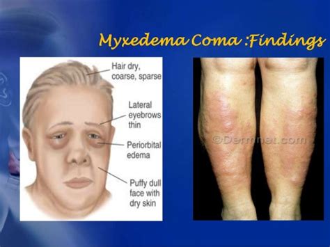 Hypothyroidismand Myxedema Crisis