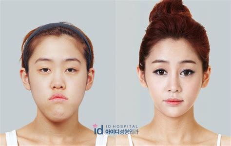 Korean Model Plastic Surgery Gone Wrong Plastic Industry In The World
