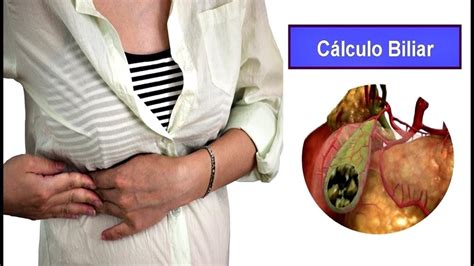 Pedra Na Vesícula é Hereditário