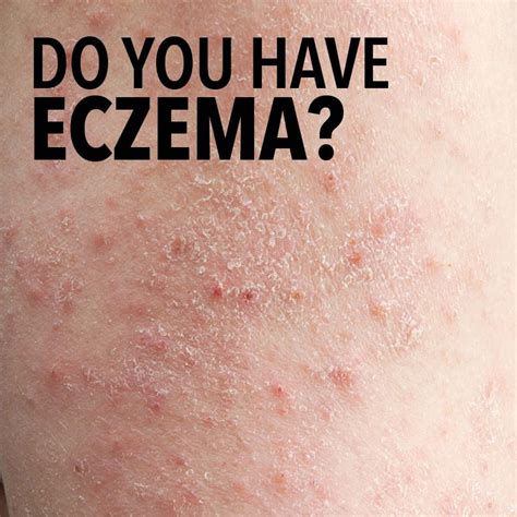 If You Have Dry Itchy And Rough Skin You May Have Eczema Itchy Dry