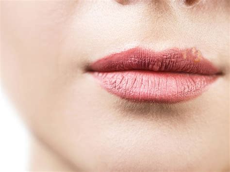 How Do You Treat Fordyce Spots On Lips At Home