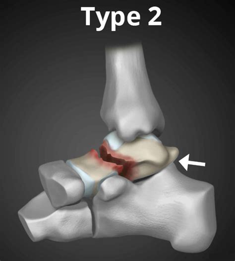 Talus Fracture Causes Types Symptoms Complications Diagnosis