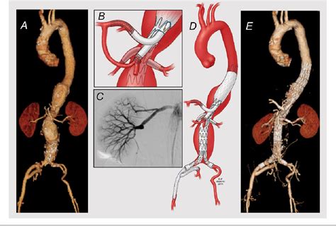 Endovascular Repair Of A Thoracoabdominal Aortic Aneurysm With A