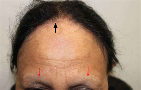 Frontal Fibrosing Alopecia Causes Symptoms Diagnosis Treatment