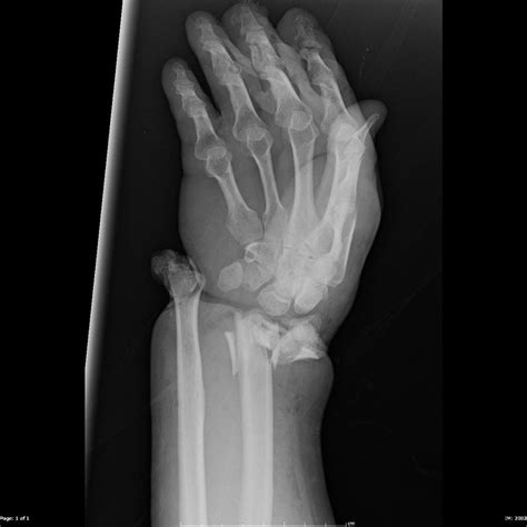 Open Fracture Dislocation Of The Wrist Buyxraysonline