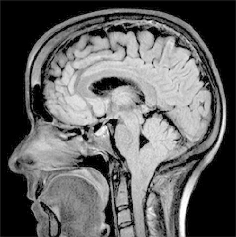 Mri Of The Discussed Patient Showing Cerebellar Tonsils Pegged And