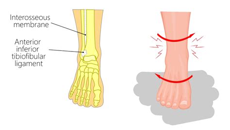 High Ankle Sprain Motus Physical Therapy