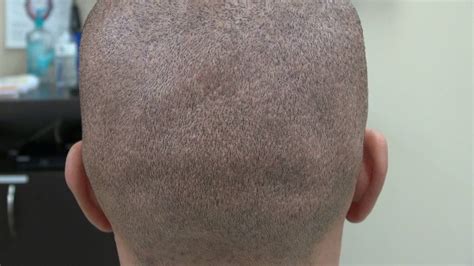 Fue Donor Scar Hair Shaved With No Guard 1 Year Follow Up Dr Diep