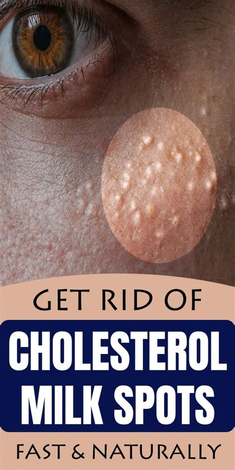 7 Remedies To Get Rid Of Cholesterol Milk Spots Naturally Skin