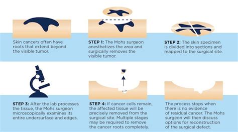 Mohs Micrographic Surgery Skin Cancer And Reconstructive Surgery Center