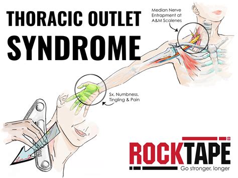 Treating Thoracic Outlet Syndrome With Iastm Rocktape