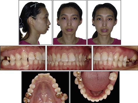Figure 1 From Orthodontic Uprighting Of A Horizontally Impacted Third