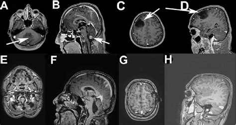 Preoperative Axial A And Sagittal B T1w Magnetic Resonance Imaging