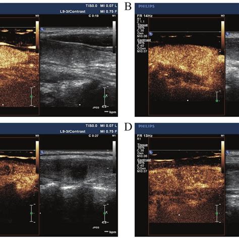 Conventional Ultrasound Of Papillary Thyroid Carcinoma Using Aa And