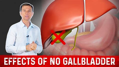 What You Must Know If You Dont Have A Gallbladder Dr Berg