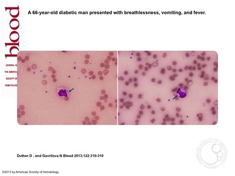 Massive Intravascular Hemolysis With Organ Failure Due To Clostridium