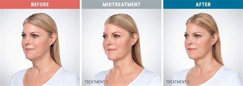Kybella Before After Photos Purely Aesthetics