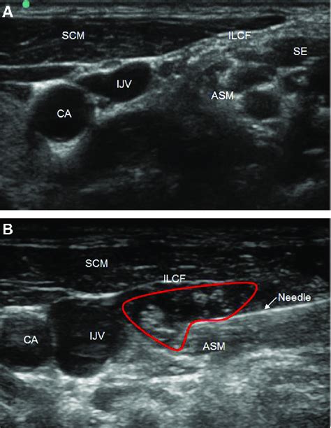 A Transverse Sonogram Of The Lateral Part Of The Neck At The C3 C4