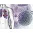 Single Cell Analysis Reveals Lung Cancer Therapy Transcriptional Changes