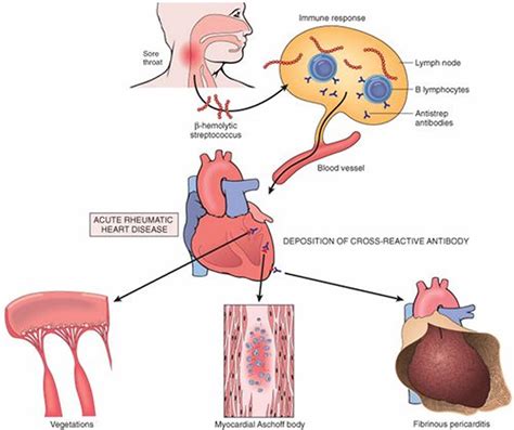 Rheumatic Heart Disease Causes Symptoms Treatment And Prevention