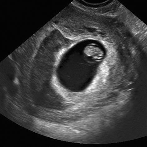 Whats Considered A Large Subchorionic Hematoma Peter Brown Bruidstaart