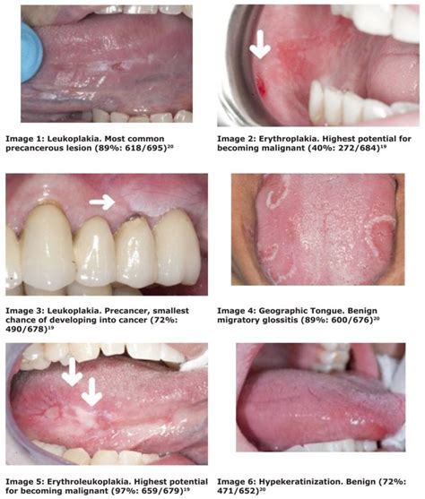 Oral Cancer Screenings Valley View Dental