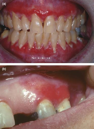 3 Common Oral Soft Tissue Lesions Pocket Dentistry