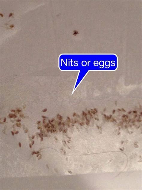 41 Best About Nits Lice Eggs Images On Pinterest Lice Eggs