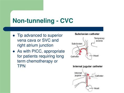 Non Tunneled Central Venous Catheter