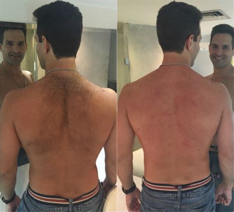 Tudo sobre Depilação a Laser Masculina: do antes e depois ao preço