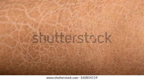 Dry Skin Ichthyosis Detail Stock Photo Edit Now 160854119