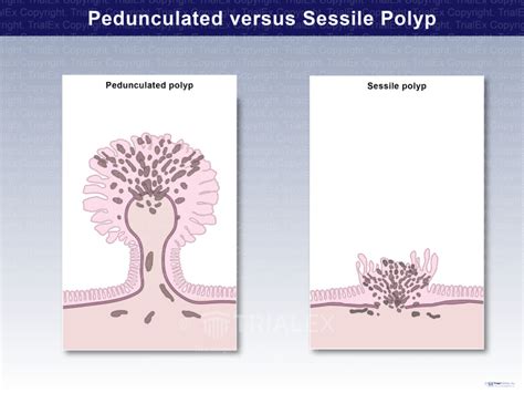 Pedunculated Versus Sessile Polyp Trial Exhibits Inc