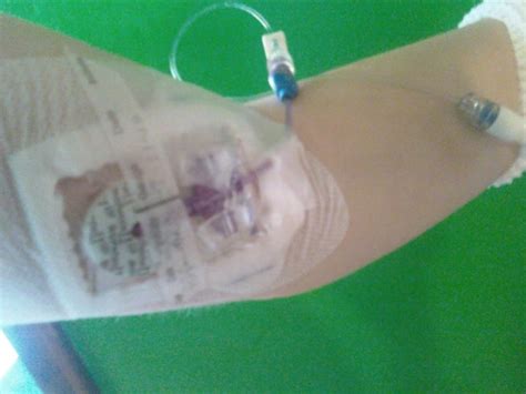 My Fight Against Lyme Disease Picc Line