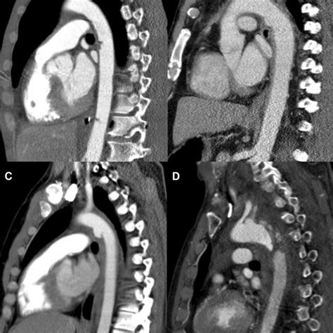 Computed Tomography Angiography Images Of The Four Azizzadeh Et Al