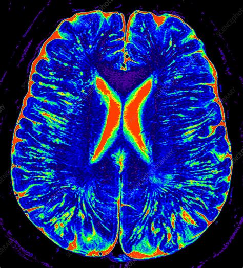 Mri Virchow Robin Spaces 4 Stock Image C0365194 Science Photo